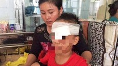 Bé trai 6 tuổi bị chó nhà cắn nát mặt