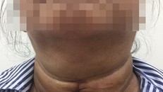 Người phụ nữ mang khối u tuyến giáp suốt 15 năm