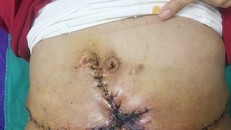 Người phụ nữ bị hoại tử bụng vì hút mỡ giảm béo