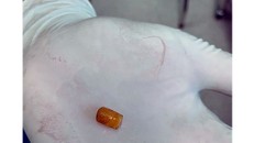 Dị vật được các bác sĩ gắp ra thành công - Ảnh: Người đưa tin