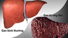 Ung thư gan là bệnh ung thư chiếm số 1 ở Việt Nam