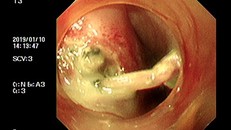 Hình ảnh xương gà găm vào thực quản qua nội soi.