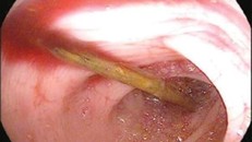 Tăm dài 5cm đâm thủng thành ruột của thanh niên 18 tuổi