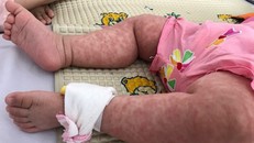 Hà Nội ghi nhận 114 ca mắc sởi trong những ngày đầu năm