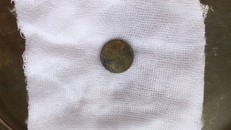 Dị vật được gắp ra là viên pin đường kính gần 1,5cm - Ảnh: Dân Việt