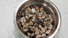 Khối lượng sỏi đá và đồng xu người đàn ông nuốt vào bụng lên tới 2kg