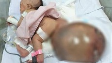 Bé gái chào đời mang khối bướu quái nặng gấp 1,5 lần cơ thể