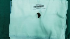 Viên đạn được gắp ra sau phẫu thuật - Ảnh: Báo Nông nghiệp VN