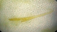 Người phụ nữ bị thủng tá tràng vì nuốt tăm xỉa răng