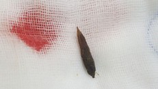 Người phụ nữ thủng ruột vì nuốt phải hạt chà là