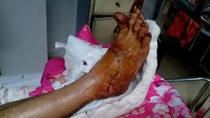 Bàn chân phải của bệnh nhân đã có dấu hiệu hồi phục - Ảnh: Dân Trí