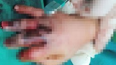 Bé trai 4 tuổi bị máy nước mía cuốn dập bàn tay