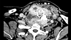 Cắt khối u bướu cổ khổng lồ cho người phụ nữ