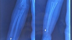 Bé 5 tuổi nhập viện cấp cứu vì trúng đạn súng hơi của hàng xóm