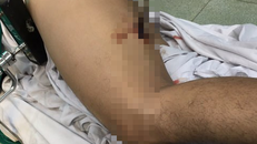 Ngã từ trên cao xuống, nam công nhân bị thanh sắt đâm xuyên đùi