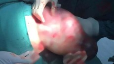 Bé gái hơn 3 kg chào đời còn nguyên trong túi ối