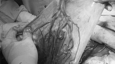 Cứu sống thai nhi bị dây rốn bám màng hiếm gặp