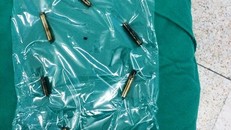 Bé trai 4 tuổi thủng ruột do nuốt 8 thanh nam châm