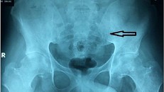 Suýt cứng khớp tay chân do nằm bất động 6 tháng trị cột sống