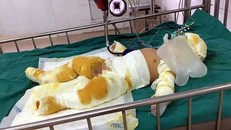 Rò rỉ gas khi nấu ăn, 3 người trong một gia đình bị bỏng nặng