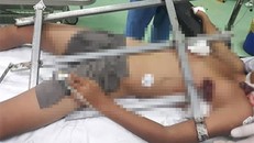 Cọc sắt đâm thấu ngực trái khiến cháu bé bất tỉnh - Ảnh: Công an Nhân dân