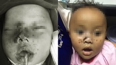 Cứu bé 9 tháng tuổi bị anh trai bắn 10 viên đạn chì vào giữa mặt