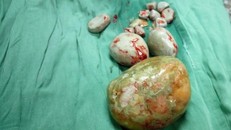 Phẫu thuật lấy viên sỏi khổng lồ cho cụ bà 84 tuổi