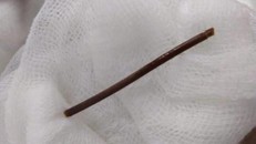 Vô tình nuốt tăm xỉa răng, cụ bà bị thủng dạ dày