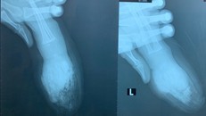 Người lớn lơ là, bé trai bị đứt lìa 4 ngón tay