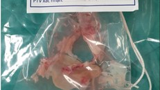 Người đàn ông giảm trí nhớ vì sán làm tổ trong não