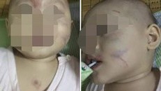 Lộ nguyên nhân bé gái 14 tháng tuổi ở Hải Phòng bầm rập trong ngày đầu đến lớp