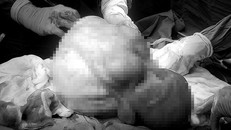 5 giờ căng thẳng lấy khối u nặng hơn 6kg cho nữ bệnh nhân