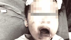 Bé gái bất tỉnh, hoại tử miệng vì nghịch cắn dây điện