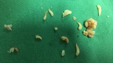 Phẫu thuật lấy gần 20 chiếc răng trong khối u của bé gái 12 tuổi