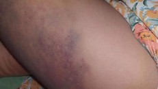 Cô giáo đánh học sinh bầm tím chân - Ảnh: VTC News