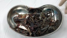 Dị vật trong người bệnh nhân được các bác sĩ lấy ra (ảnh bệnh viện cung cấp)