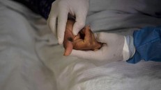 Bàn tay của một bệnh nhân đậu mùa khỉ. Ảnh: AFP