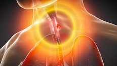 Trong một số phương pháp điều trị và đặc biệt là trong trường hợp hóa trị, bệnh nhân ung thư thực quản có thể mất vị giác hoặc vị giác bị thay đổi. (Nguồn: Getty Images)