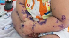 Đặc trưng của bệnh tay chân miệng là nổi mụn nước xung quanh miệng, tay và chân. (Ảnh: Đinh Hằng/TTXVN)