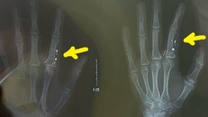 Cảnh báo nhiễm độc thủy ngân từ vật dụng quen thuộc