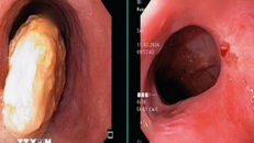 Thủng ruột non do nuốt phải hạt táo đỏ