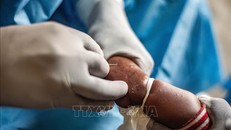 Nhân viên y tế điều trị cho em nhỏ mắc đậu mùa khỉ tại Nyiragongo, Bắc Kivu, CHDC Congo ngày 15/8/2024. Ảnh: THX/TTXVN