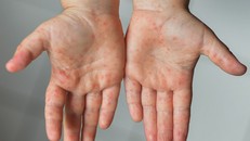 Nhiều nguy cơ dịch bệnh lúc chuyển mùa