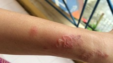 Mắc giun đũa chó mèo từ chó nuôi trong nhà