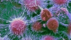 90% nguyên nhân gây ung thư là do lối sống