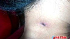 Bệnh lạ xuất hiện ở Hà Tĩnh có thể gây chết người