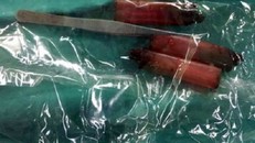 Chồng nuốt chửng nhíp và 3 chiếc bật lửa vào bụng vì giận vợ