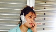 Đi nhậu về, chồng cắn đứt lìa tai vợ