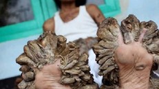 10 chứng bệnh kỳ quái nhất mà con người đang mắc