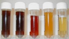 Màu của nước tiểu cảnh báo bệnh trong cơ thể